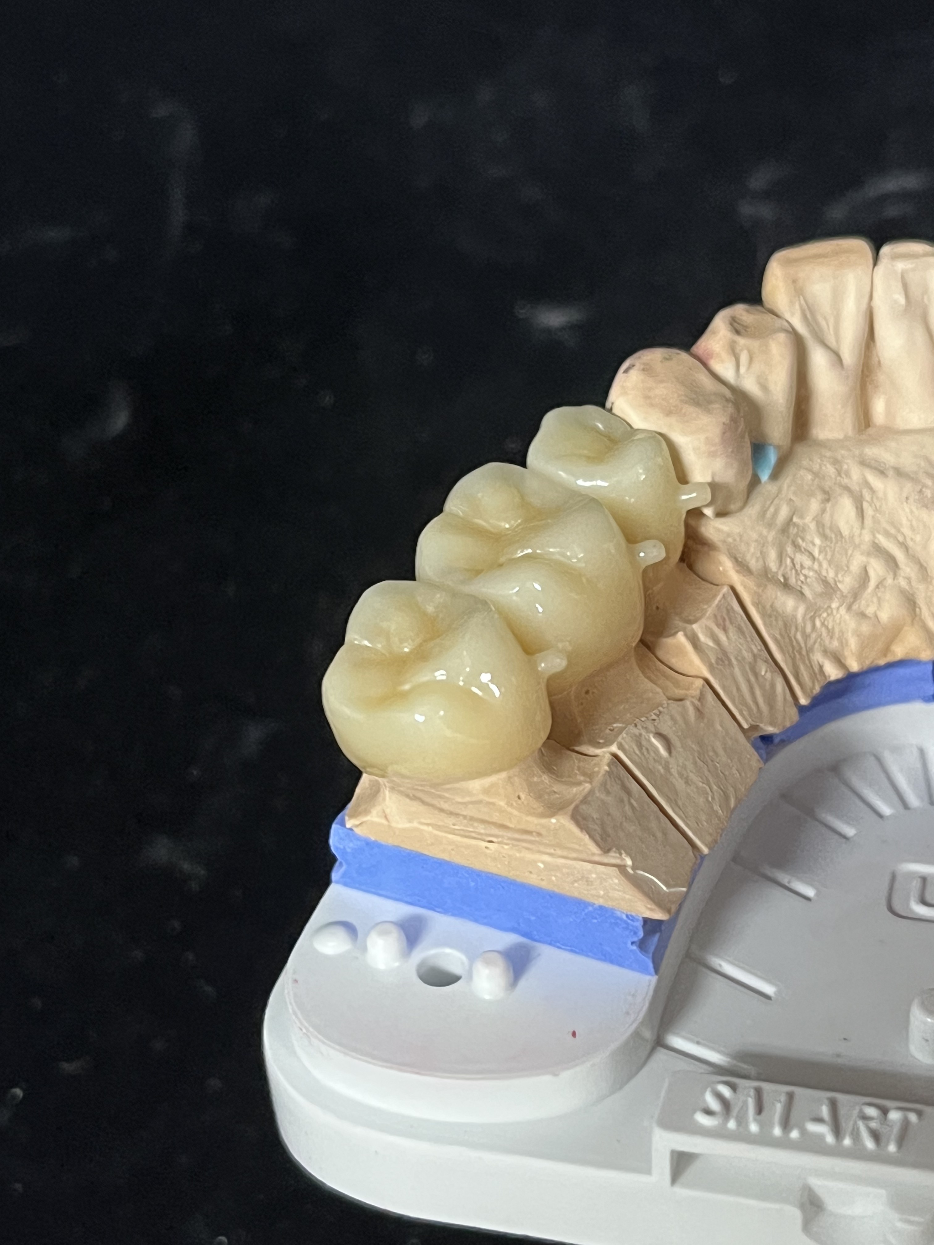 지르코니아 크라운